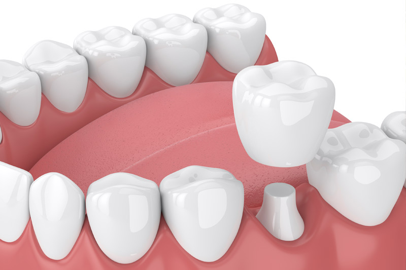 Emergency Dental Crowns in Fairlawn