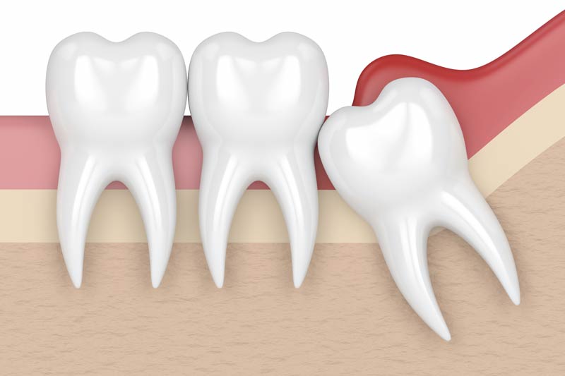 Wisdom Tooth Removal in Fairlawn